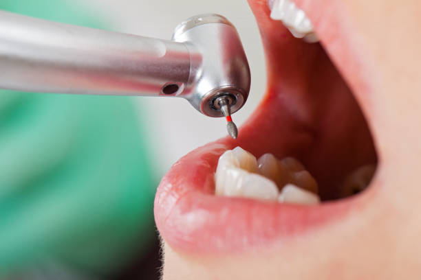 Best Dentist for Tooth Abscess  in Reserve, LA